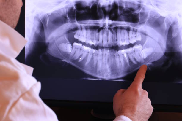 Best Emergency Dental Care for Broken or Chipped Teeth in Upper Montclair, NJ